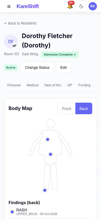 Body Map — Back: Back view with sacrum and heel pressure injuries recorded. (mobile view)